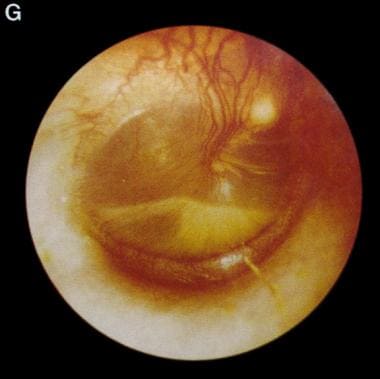 Days after onset of symptoms, vessels continue acr