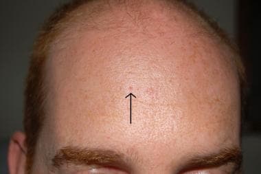 Dilated pore of Winer on forehead. 