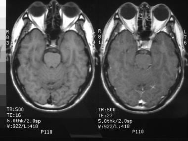 MRI of a 40-year-old man with severe periorbital p