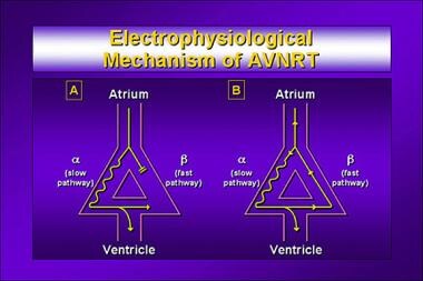 Atrioventricular Nodal Reentry Tachycardia. Electr