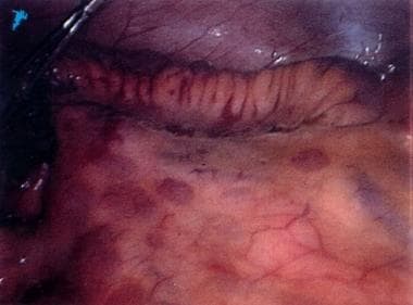 Crohn disease. This laparoscopic view depicts cree