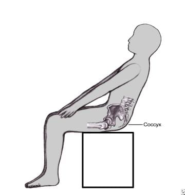 Coccyx pain (coccydynia, or tailbone pain) is typi