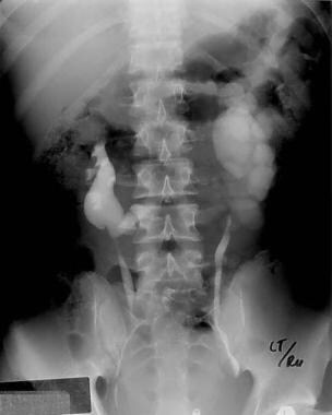 Excretory urogram shows a horseshoe kidney with le