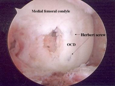 Completed osteochondritis dissecans stabilization 