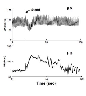 Immediate Orthostatic Hypotension (IOH) upon stand