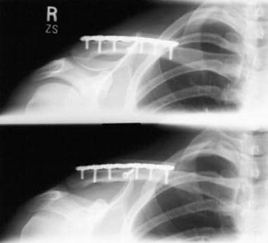 Radiographs after open reduction and internal fixa