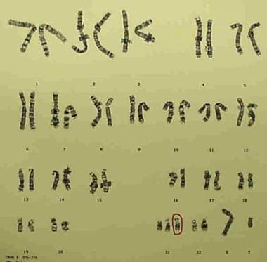 G-banded karyotype showing trisomy 21 (47,XY,+21).