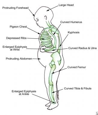 Findings in patients with rickets. 