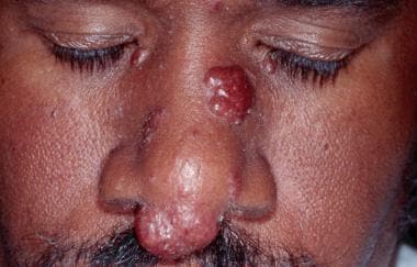 Lupus pernio with nodules on the nasal tip and sid