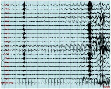 EEG seizure, left temporal region. This is charact