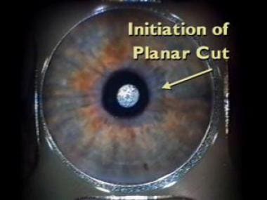 A glass applanation lens is placed onto the cornea
