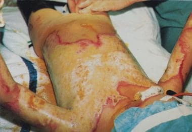 Clinical aspects of full-thickness wound healing