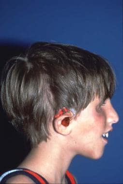 Same patient with Treacher Collins syndrome. Posto