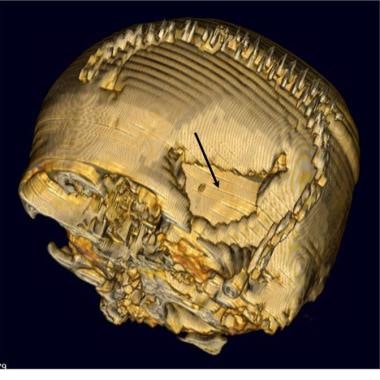 Brain abscess. Three-dimensional surface model of 