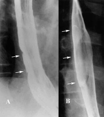 Infectious esophagitis. Two examples of giant HIV 