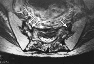 Axial T2-weighted MRI of the sacrum demonstrates l
