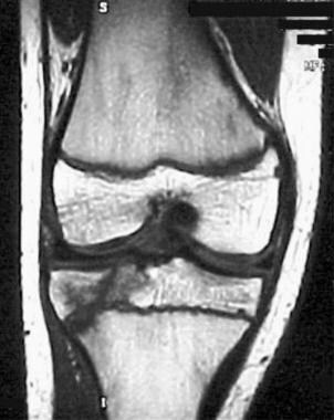 Coronal MRI obtained several weeks after an initia