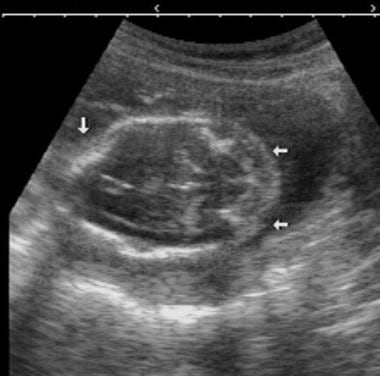 Antenatal ultrasonogram shows a lemon sign and a b