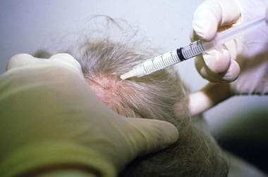 Side effects of steroids injections for alopecia