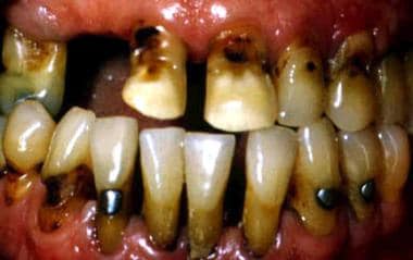 Root surface caries, severe periodontitis, and ama