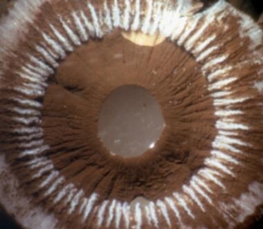 Postmortem appearances in an eye with an iris claw