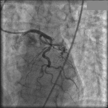 Takotsubo (stress) cardiomyopathy (broken heart sy