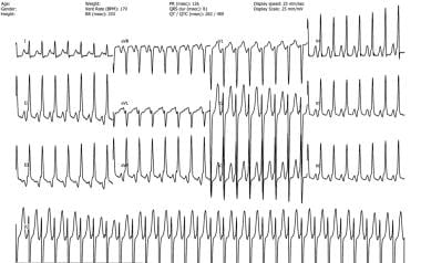 Atrioventricular Nodal Reentry Tachycardia. Atypic