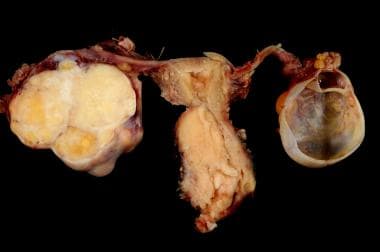 Cervical carcinoma with adnexa. 