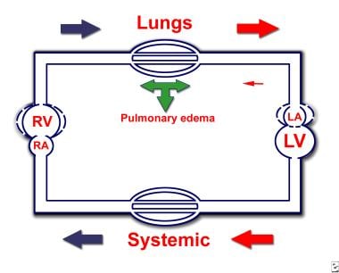 Congenital Mitral Stenosis. Hemodynamic changes in