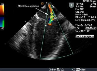 This is an intraoperative transesophageal, transve