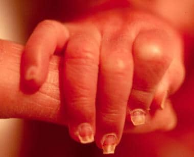 Dystrophic nails in a neonate with junctional epid