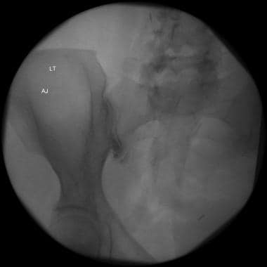 Bilateral sacroiliac joint steroid injection