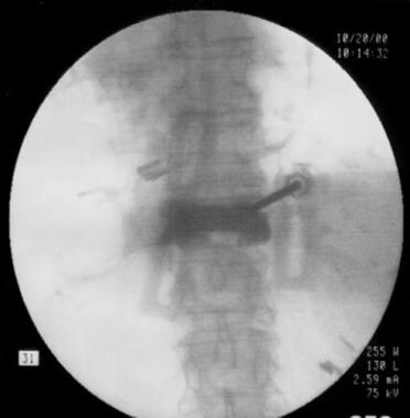 Percutaneous vertebroplasty, transpedicular approa
