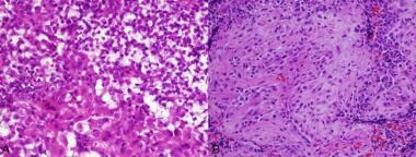 Pathology of Embryonal Tumors. (A): Regional cytop