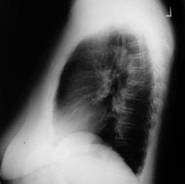 Lateral radiograph of the patient in the previous 