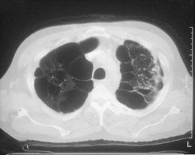 Chronic obstructive pulmonary disease (COPD). A CT