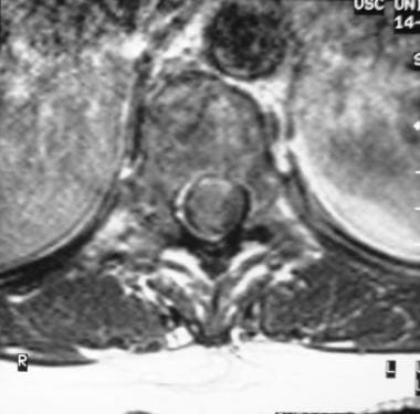 Axial T1-weighted contrast-enhanced MRI shows a ri