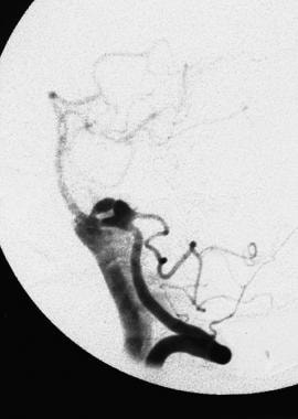 A later-phase angiogram of a rupturing bilobed ane