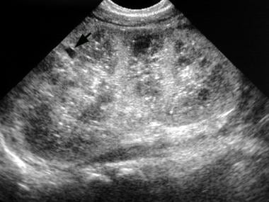 kidney polycystic recessive autosomal arpkd ultrasound echogenic newborn imaging emedicine sagittal elongated sonogram