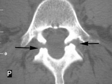 Spondylolisthesis. Axial CT image shows bilateral 