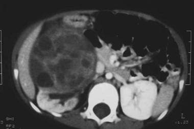 Contrast-enhanced axial CT scan in the same patien