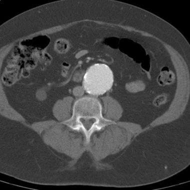 CT demonstrates an abdominal aortic aneurysm. The 