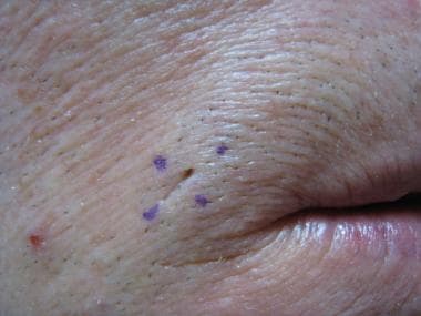 Dilated pore of Winer on lateral upper labial regi