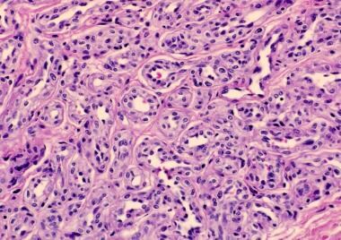 Histopathology of a proliferating infantile hemang