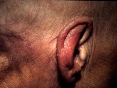 Acrokeratosis paraneoplastica. A 67-year-old woman