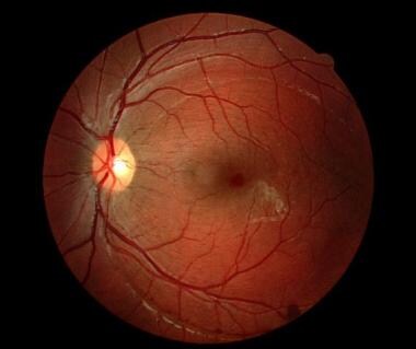 At 4-month follow-up of the same patient as in the