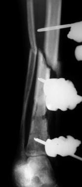 Tibial nonunions. Oblique view of tibial fracture