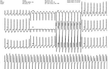 Atrioventricular Nodal Reentry Tachycardia. Typica