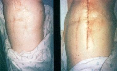Classic multiple scarred abdomen of woman with Mun