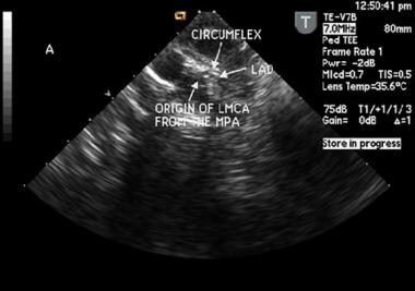 This is an intraoperative transesophageal, transve